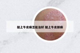 腿上牛皮癬怎能治好 腿上牛皮膚癬