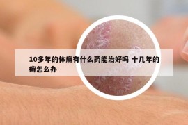 10多年的體癬有什么藥能治好嗎 十幾年的癬怎么辦