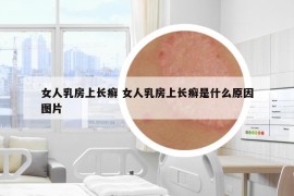 女人乳房上長癬 女人乳房上長癬是什么原因圖片
