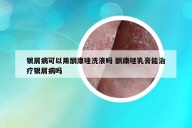 銀屑病可以用酮康唑洗液嗎 酮康唑乳膏能治療銀屑病嗎