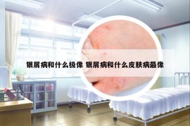 銀屑病和什么極像 銀屑病和什么皮膚病最像