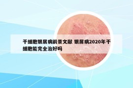 干細(xì)胞銀屑病前景文獻(xiàn) 銀屑病2020年干細(xì)胞能完全治好嗎