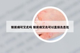 銀屑病可艾炙嗎 銀屑病艾灸可以直接灸患處