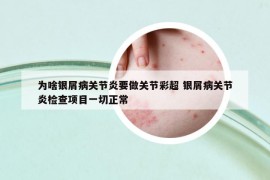 為啥銀屑病關節(jié)炎要做關節(jié)彩超 銀屑病關節(jié)炎檢查項目一切正常