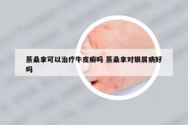 蒸桑拿可以治療牛皮癬嗎 蒸桑拿對(duì)銀屑病好嗎