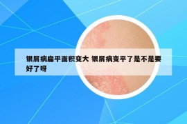 銀屑病扁平面積變大 銀屑病變平了是不是要好了呀