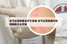 白芍總苷膠囊治療牛皮癬 白芍總苷膠囊對(duì)皮膚病有什么作用