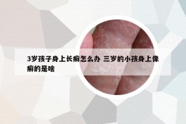 3歲孩子身上長癬怎么辦 三歲的小孩身上像癬的是啥