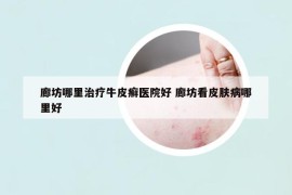 廊坊哪里治療牛皮癬醫(yī)院好 廊坊看皮膚病哪里好