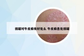 拔罐對牛皮癬有好處么 牛皮癬患處拔罐