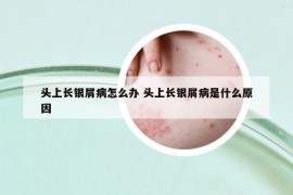 頭上長(zhǎng)銀屑病怎么辦 頭上長(zhǎng)銀屑病是什么原因