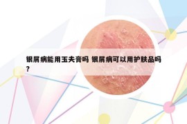 銀屑病能用玉夫膏嗎 銀屑病可以用護(hù)膚品嗎?