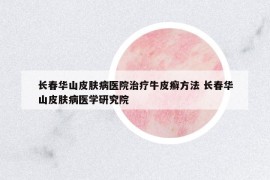 長(zhǎng)春華山皮膚病醫(yī)院治療牛皮癬方法 長(zhǎng)春華山皮膚病醫(yī)學(xué)研究院