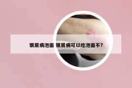 銀屑病泡面 銀屑病可以吃泡面不?