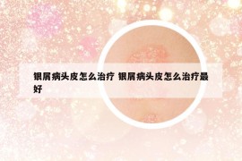 銀屑病頭皮怎么治療 銀屑病頭皮怎么治療最好