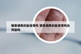 銀屑病男的能接受嗎 銀屑病男的能接受嗎會傳染嗎