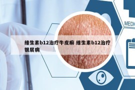 維生素b12治療牛皮癬 維生素b12治療銀屑病