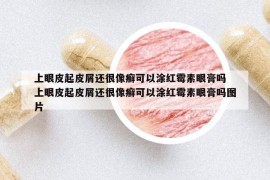 上眼皮起皮屑還很像癬可以涂紅霉素眼膏嗎 上眼皮起皮屑還很像癬可以涂紅霉素眼膏嗎圖片