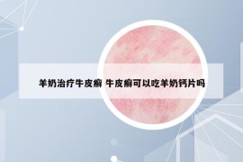 羊奶治療牛皮癬 牛皮癬可以吃羊奶鈣片嗎