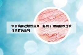 銀屑病和過(guò)敏性皮炎一起的了 銀屑病跟過(guò)敏體質(zhì)有關(guān)系嗎