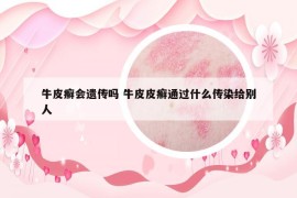 牛皮癬會遺傳嗎 牛皮皮癬通過什么傳染給別人