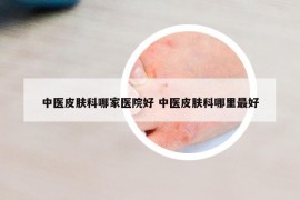 中醫(yī)皮膚科哪家醫(yī)院好 中醫(yī)皮膚科哪里最好