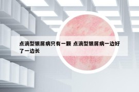 點(diǎn)滴型銀屑病只有一顆 點(diǎn)滴型銀屑病一邊好了一邊長(zhǎng)