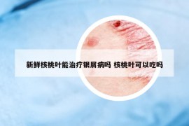 新鮮核桃葉能治療銀屑病嗎 核桃葉可以吃嗎