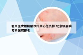北京醫(yī)大銀屑病診療中心怎么樣 北京銀屑病?？漆t(yī)院排名