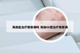 海南能治療銀屑病嗎 海南66度治療銀屑病
