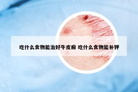 吃什么食物能治好牛皮癬 吃什么食物能補(bǔ)鉀