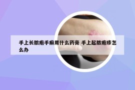 手上長膿皰手癬用什么藥膏 手上起膿皰疹怎么辦