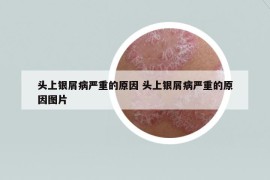 頭上銀屑病嚴(yán)重的原因 頭上銀屑病嚴(yán)重的原因圖片