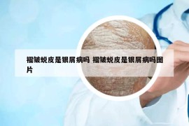 褶皺蛻皮是銀屑病嗎 褶皺蛻皮是銀屑病嗎圖片