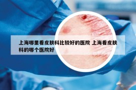 上海哪里看皮膚科比較好的醫(yī)院 上?？雌つw科的哪個醫(yī)院好