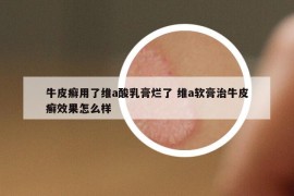 牛皮癬用了維a酸乳膏爛了 維a軟膏治牛皮癬效果怎么樣