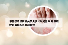 甲氨蝶呤銀屑病關(guān)節(jié)炎多長(zhǎng)時(shí)間見(jiàn)效 甲氨蝶呤銀屑病多長(zhǎng)時(shí)間起效