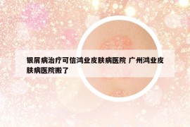 銀屑病治療可信鴻業(yè)皮膚病醫(yī)院 廣州鴻業(yè)皮膚病醫(yī)院搬了