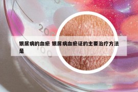 銀屑病的血瘀 銀屑病血瘀證的主要治療方法是