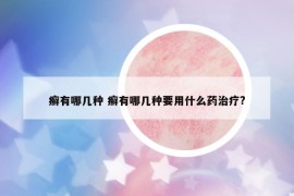 癬有哪幾種 癬有哪幾種要用什么藥治療?