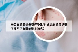 老公有銀屑病老婆懷孕生子 丈夫有銀屑病妻子懷孕了會影響到小孩嗎?