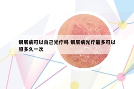 銀屑病可以自己光療嗎 銀屑病光療最多可以照多久一次
