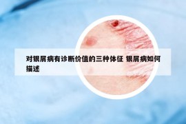 對(duì)銀屑病有診斷價(jià)值的三種體征 銀屑病如何描述