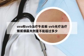 uva和uvb治療牛皮癬 uvb光療治療銀屑病最大劑量不能超過(guò)多少