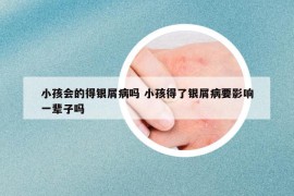 小孩會的得銀屑病嗎 小孩得了銀屑病要影響一輩子嗎