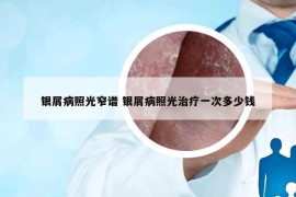 銀屑病照光窄譜 銀屑病照光治療一次多少錢