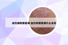 血熱病和銀屑病 血熱和銀屑病什么關(guān)系