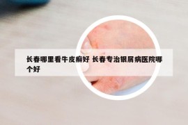 長春哪里看牛皮癬好 長春專治銀屑病醫(yī)院哪個好
