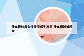 什么樣的癬會慢慢變成牛皮癬 什么癬越長越大