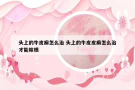 頭上的牛皮癬怎么治 頭上的牛皮皮癬怎么治才能除根